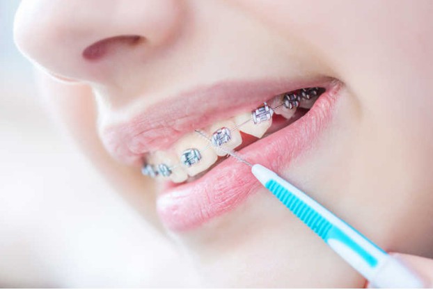 沈阳牙齿矫正多少钱,有多少纠正的方法?