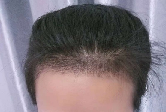 fut植发和fue植发的区别在哪里,两种方式该如何选择?