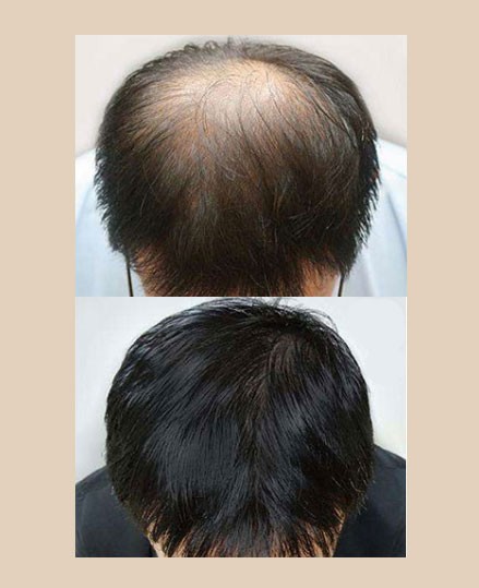 fut植发和fue植发的区别在哪里,两种方式该如何选择?