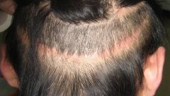 fut植发果怎么样？有什么优点？