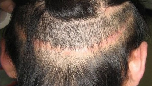 fut植发果怎么样?有什么优点?