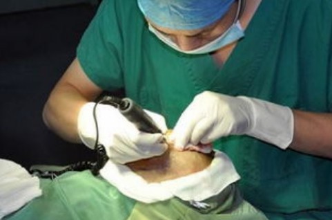 fut植发果怎么样?有什么优点?