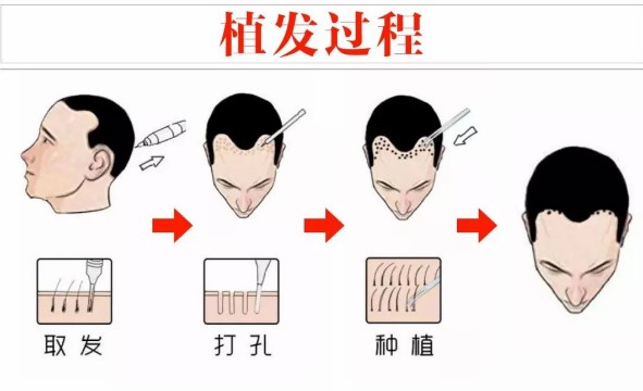 fut植发果怎么样?有什么优点?