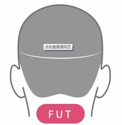fut植发果怎么样?有什么优点?