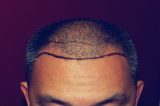 丽格植发怎么样？丽格植发医生名单推荐