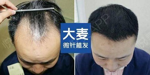 大麦微针植发怎么样?到底靠不靠谱,值得选择吗?
