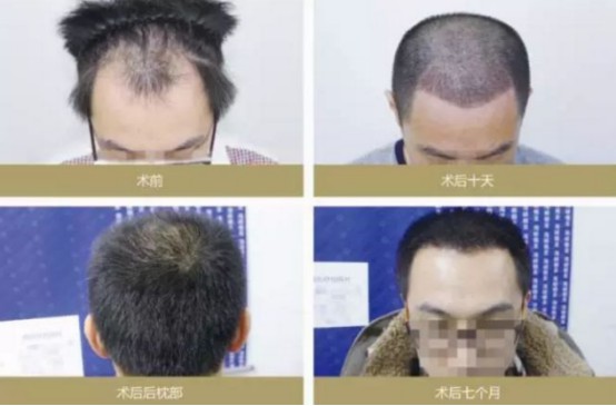 海峡植发怎么样？靠谱吗？医生怎么样？