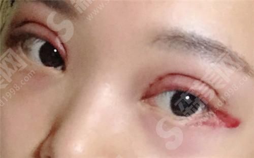 大连新华美天医疗美容医院怎么样?医生技术+真实整形案例!