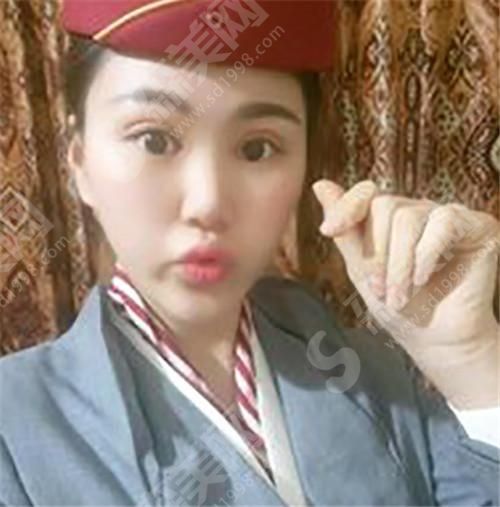 上海妮巧儿医院整形案例