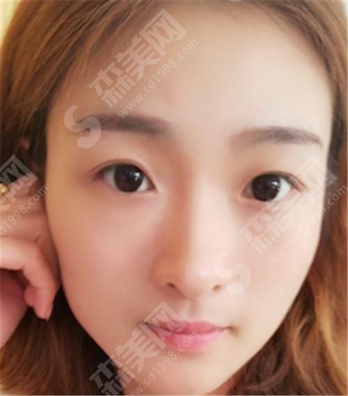 郑州华领医疗美容医院张宛霞整形案例 郑州华领医疗美容医院好吗?医院整形医生和案例(附照片)