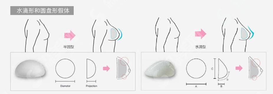 1629472780549461.jpg 深圳做隆胸手术多少钱?隆胸的技术有哪几种&优势&真人案例果好不好?