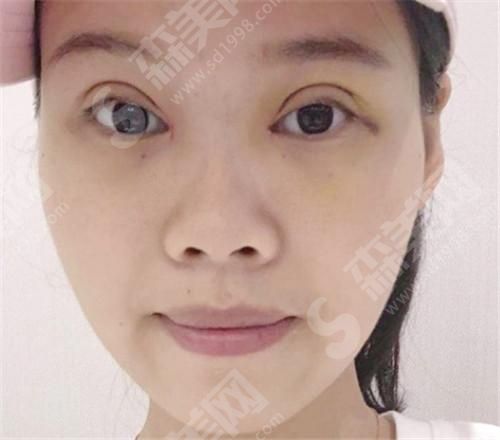 成都格莱丽石峰整形案例