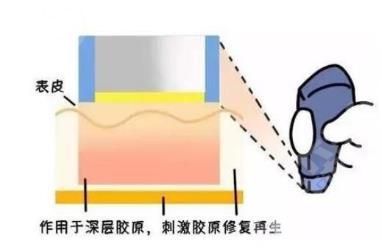 热玛吉操作的过程是怎样的? 热玛吉全脸一次多少钱?操作过程?有什么副作用呢!