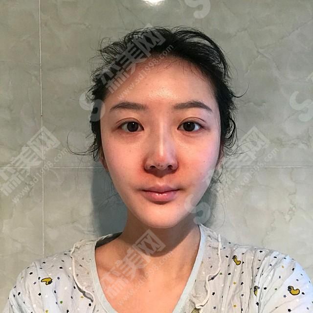 1629630089275545.jpg 沈阳元辰整形医院怎么样?医院的技术/医院的优势/医生介绍&附带的隆鼻案例