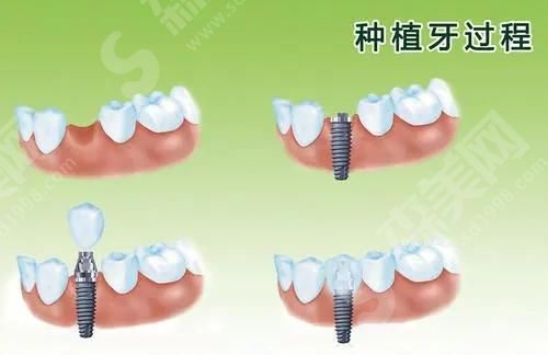 大同美源口腔医院的牙齿种植技术.jpg 大同美源口腔医院收费高吗?牙齿种植的技术&真人的案例果恢复图分享!