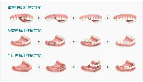 大同美源口腔医院的口碑.jpg 大同美源口腔医院收费高吗?牙齿种植的技术&真人的案例果恢复图分享!