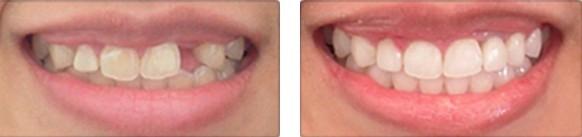 大同美源口腔医院牙齿种植的术后果.jpg 大同美源口腔医院收费高吗?牙齿种植的技术&真人的案例果恢复图分享!