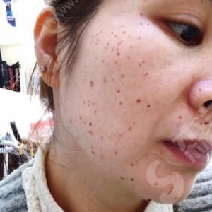 保定华中医疗美容医院激光美肤激光祛斑.jpg