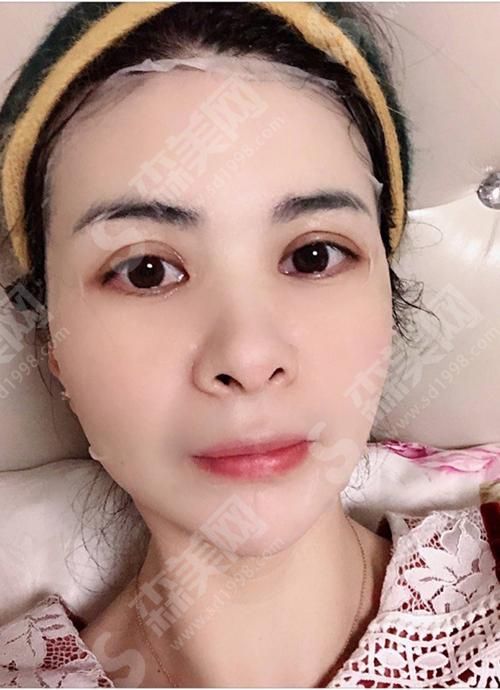 保定华中医疗美容医院激光美肤激光祛斑恢复过程.jpg