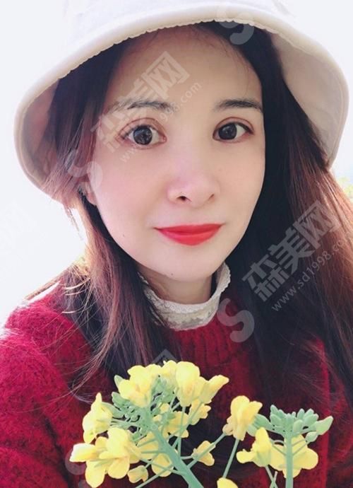 保定华中医疗美容医院激光美肤激光祛斑恢复过程.jpg