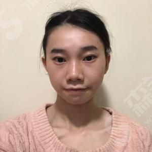 热玛吉做一次有果吗？热玛吉的优势/果/流程/真人案例的果图！