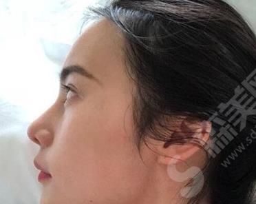 上海港华医院隆鼻案例分享 上海港华医院怎么样?医生推荐/隆鼻案例分享/价格表