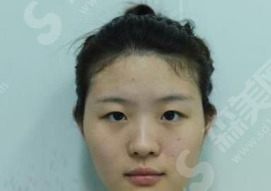 北京韩勋双眼皮修复真人案例