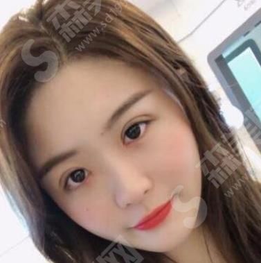 双眼皮修复真人案例