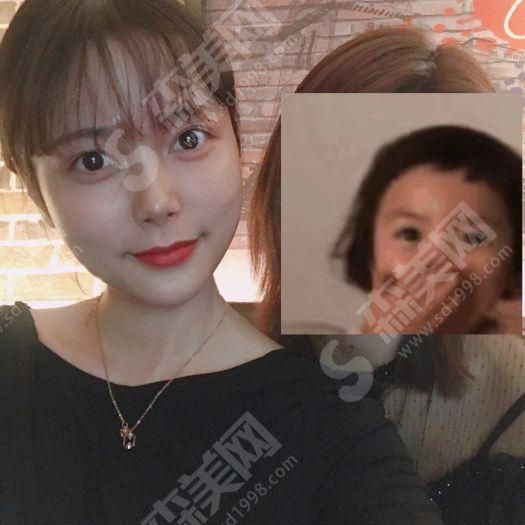 热玛吉的治疗过程痛苦吗.jpg