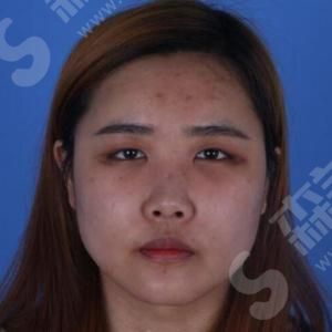 西安伊美尔整形医院眼部手术的果.jpg 西安伊美尔整形医院怎么样?医院概况/医生技术,附了眼部手术的案例果图!