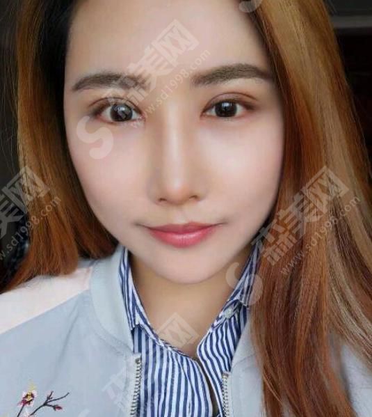 西安伊美尔整形医院眼部手术的果.jpg 西安伊美尔整形医院怎么样?医院概况/医生技术,附了眼部手术的案例果图!