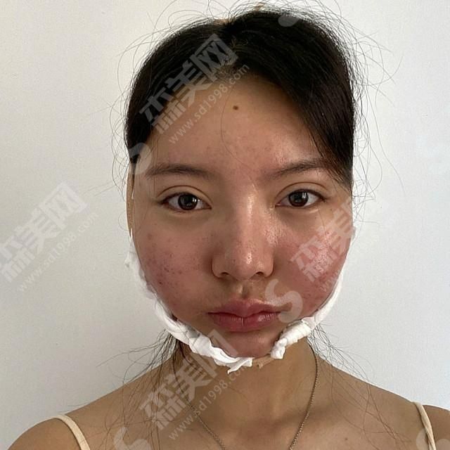 上海九院郭军医生颌面整形的果.jpg 上海九院郭军颌面整形案例分享!医生技术口碑好吗?真人案例果赏析