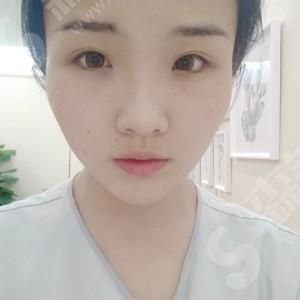 双眼皮修复的果.jpg