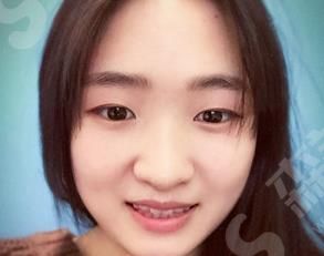 张英医生双眼皮真人案例