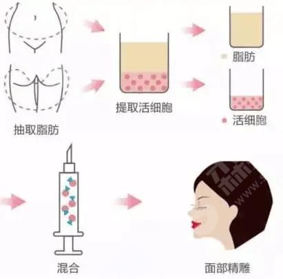 脂肪胶填充技术.jpg