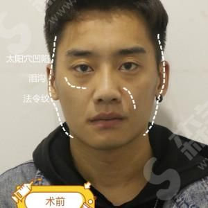 脂肪胶填充的优势.jpg