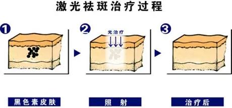激光祛斑果好吗.jpg