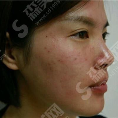 激光美肤激光的技术优势.jpg