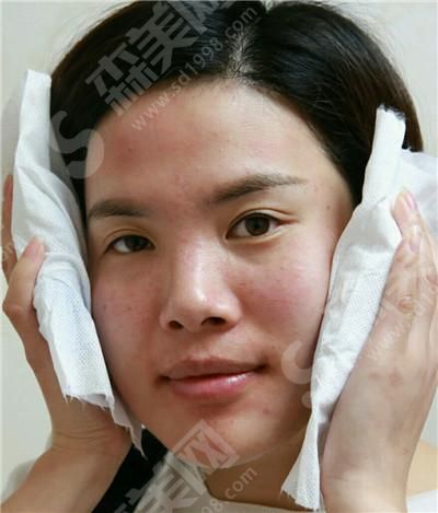 激光美肤激光祛斑的恢复过程.jpg