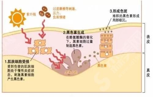 杭州市三医院祛斑技术.jpg