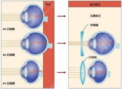 济南近视激光手术多少钱？案例果展示&激光近视的优势特点