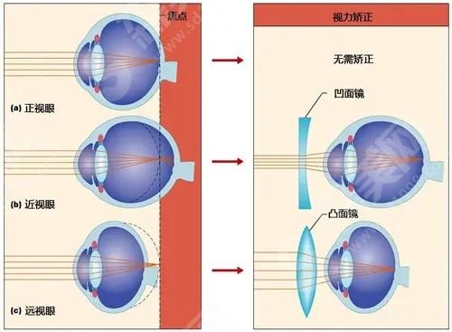济南近视激光手术有哪些方式方法.jpg
