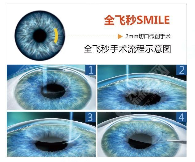 济南近视激光手术的优势特点.jpg