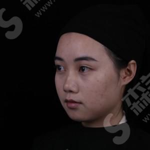 1632982630948178.jpg 西京医院隆鼻技术怎么样?综合实力好吗?隆鼻的案例果赏析!