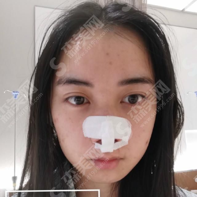 西京医院隆鼻技术怎么样？综合实力好吗？隆鼻的案例果赏析！