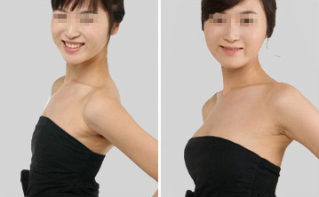 张楠医生的自体脂肪隆胸让我变得特别有女人味!郑州中心医院美容科的具体情况?