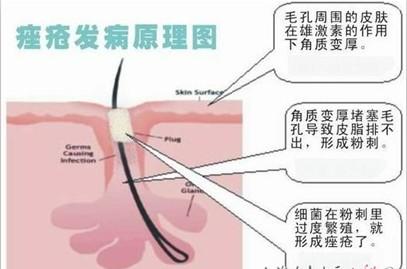 皮肤医院治疗痘痘费用贵吗