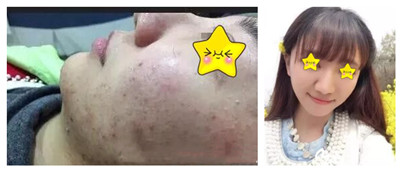 皮肤医院治疗痘痘费用贵吗