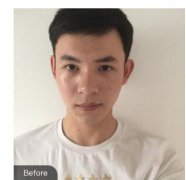 隆鼻后让我变得更加帅气，感谢北京八大处