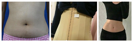 合肥韩美整形医院靠谱吗？进行吸脂减肥的果好吗？